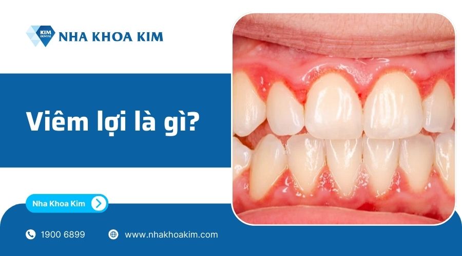 bệnh viêm lợi là gì?