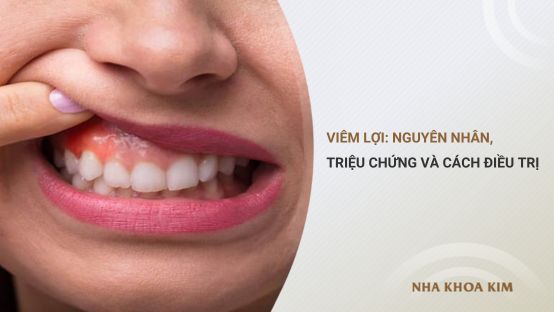 Viêm lợi: Nguyên nhân, dấu hiệu nhận biết và cách điều trị