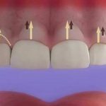 Cắt lợi làm dài răng chữa cười hở lợi nhanh chóng, không đau Cắt lợi làm dài răng chữa cười hở lợi nhanh chóng, không đau