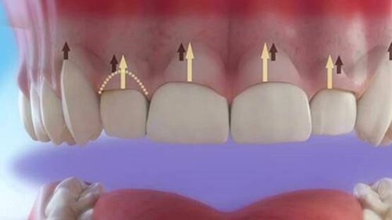 Cắt lợi làm dài răng chữa cười hở lợi nhanh chóng, không đau