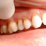 Hở chân răng - Tìm hiểu nguyên nhân và phương pháp điều trị Hở chân răng - Tìm hiểu nguyên nhân và phương pháp điều trị
