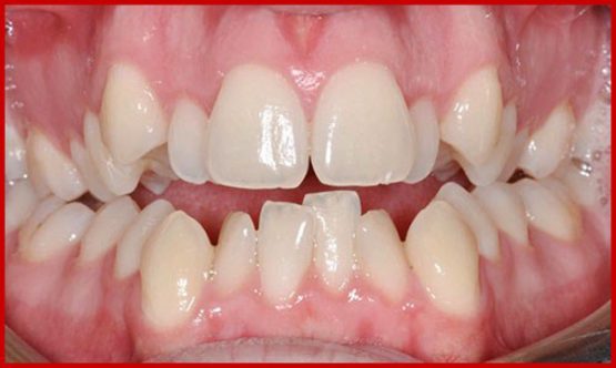 Răng bị lòi xỉ là gì? Điều trị bằng cách nào hiệu quả nhất?