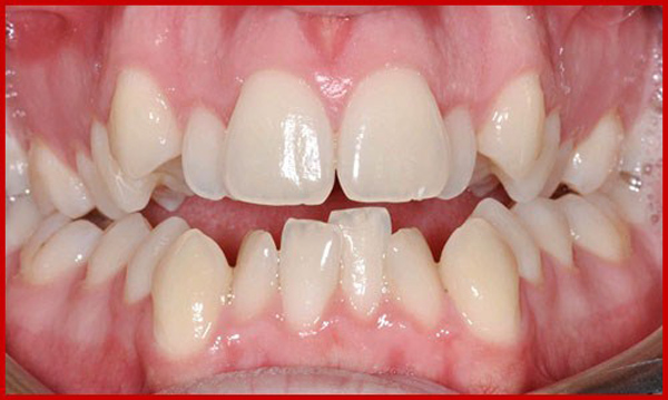 Tự điều trị răng lòi xỉ xấu có thể làm được không?