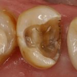 Đầy đủ thông tin về răng bị mục từ A-Z Đầy đủ thông tin về răng bị mục từ A-Z