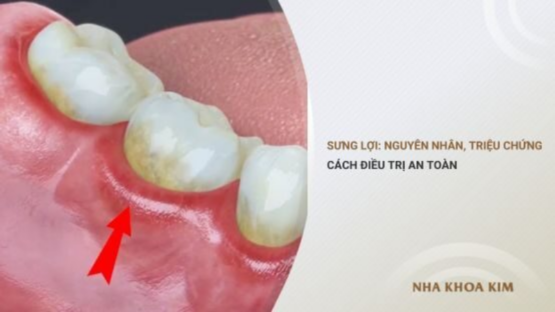 Sưng lợi: Nguyên nhân, triệu chứng và cách điều trị an toàn