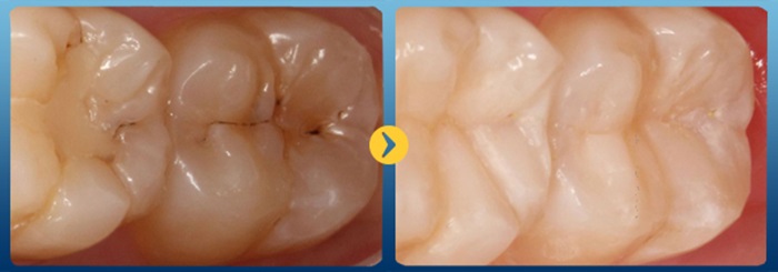 trám men răng - điều trị răng lồi lõm, bị đen