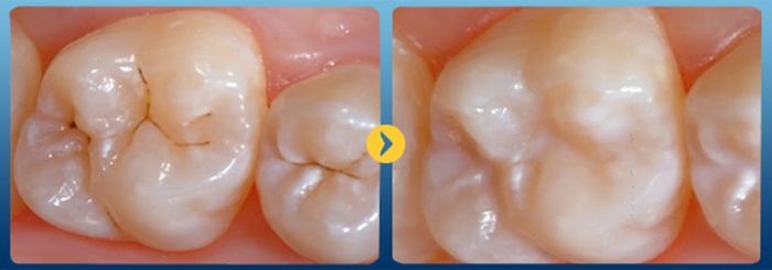 Trám men răng - trị răng bị đen