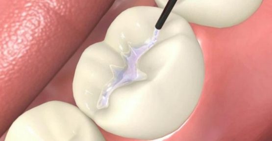 Trám răng là gì? Quy trình trám răng thẫm mỹ chuẩn y khoa