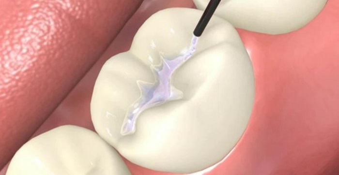Trám răng là gì? Cách vệ sinh răng miệng đúng sau trám răng