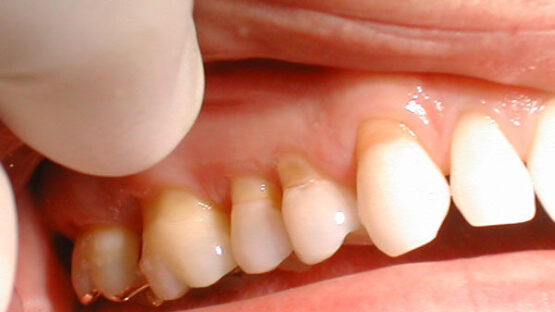 Trám khe răng – Khôi phục thẩm mỹ một cách nhanh chóng