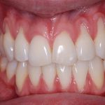 Tụt lợi là gì? Nguyên nhân và cách chữa trị hiệu quả? Tụt lợi là gì? Nguyên nhân và cách chữa trị hiệu quả?