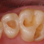 Răng bị thủng lỗ do sâu răng - Điều trị bằng cách nào tốt nhất? Răng bị thủng lỗ do sâu răng - Điều trị bằng cách nào tốt nhất?