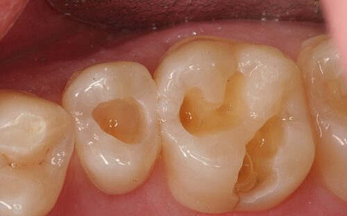 Răng bị thủng lỗ do sâu răng điều trị bằng cách nào?