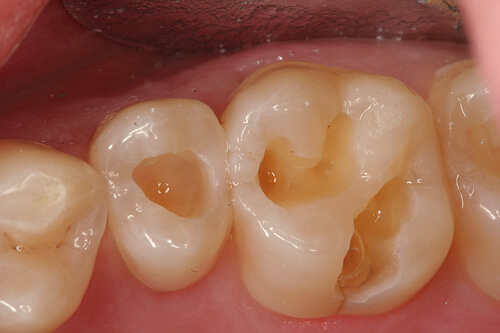 Bệnh sâu răng đã tiến triển nặng sẽ gây ra những hệ quả gì cho răng và cách xử lý như thế nào?