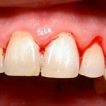 Viêm lợi là gì & điều trị bằng cách nào nhanh, hiệu quả nhất? Viêm lợi là gì & điều trị bằng cách nào nhanh, hiệu quả nhất?