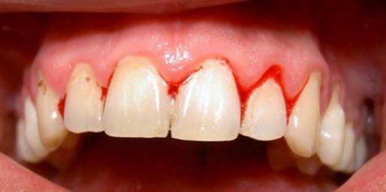 Viêm lợi là gì và điều trị bằng cách nào nhanh, hiệu quả nhất?