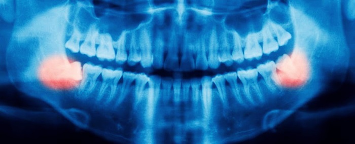 Mọi thông tin quan trọng cần biết về chụp X-Quang răng 2