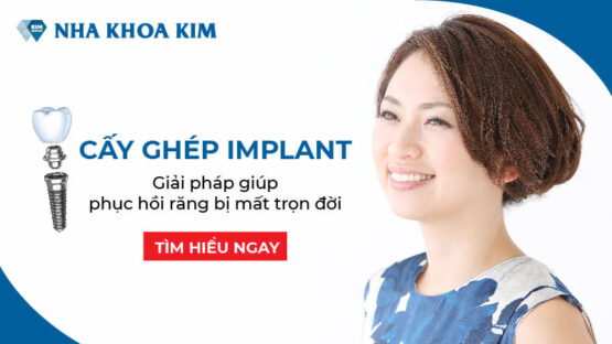 Cấy ghép Implant là gì? Có nên cấy Implant không?