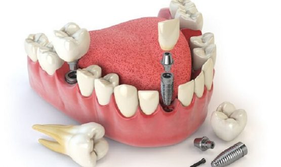 Trồng răng Implant Fast 3D – Phương pháp phục hình răng tân tiến từ Mỹ