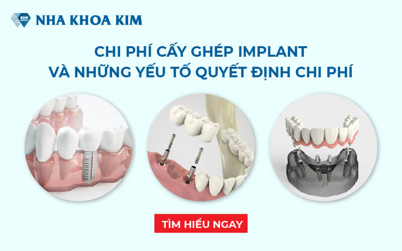 Bảng giá trồng răng implant tại Nha khoa Kim có giá như thế nào?