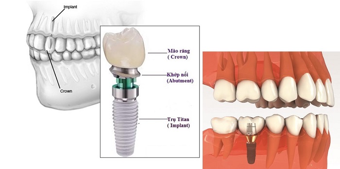 Giá làm răng implant 3