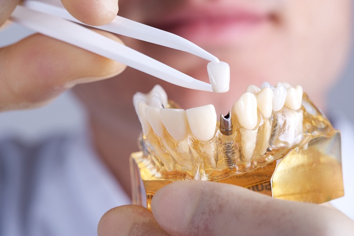 Trồng răng implant - giải pháp cho trường hợp mất răng - Nha Khoa Kim