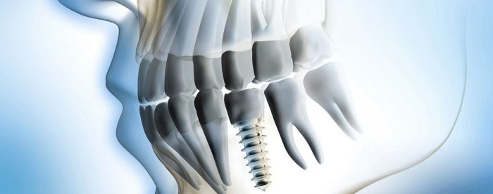 Trồng răng Implant Fast 3D - Phương pháp phục hình răng tân tiến từ Mỹ 2