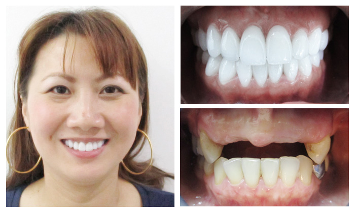 81 khách hàng được trồng răng implant miễn phí tại Nha khoa KIM 6