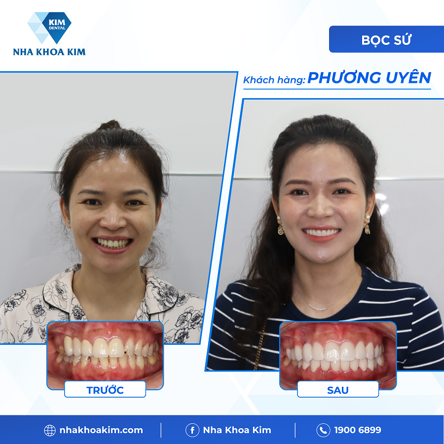 Hình ảnh khách hàng trước - sau khi tới với Nha Khoa Kim Biên Hoà