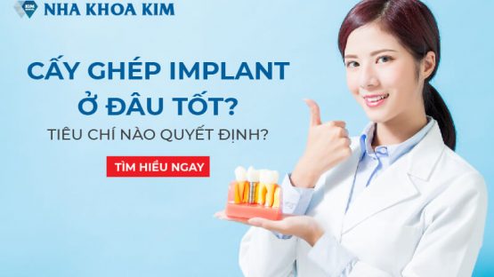 Cấy ghép Implant ở đâu tốt? Tiêu chí nào quyết định?