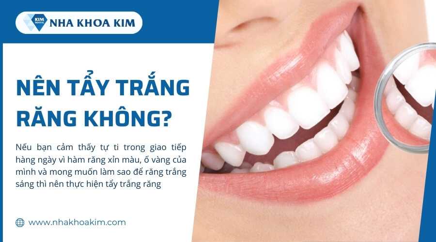 Có nên tẩy trắng răng không?