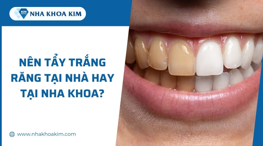 Nên tẩy trắng răng tại nhà hay nha khoa?