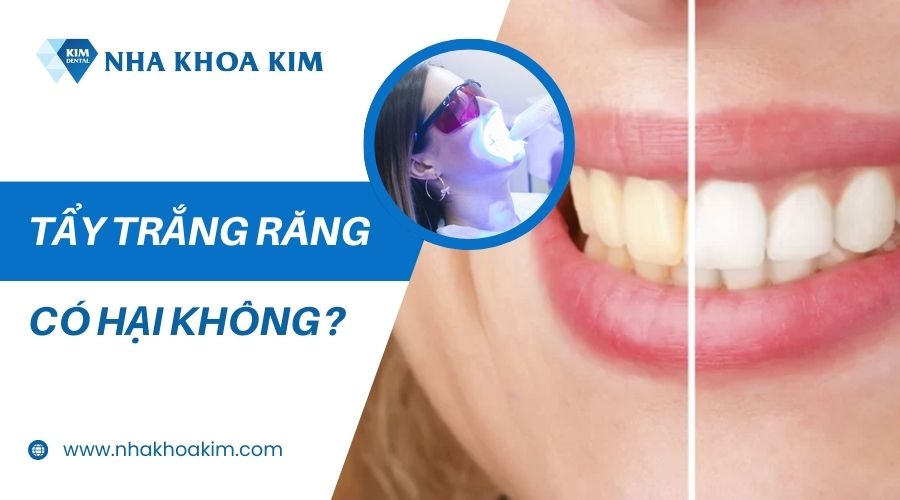 Tẩy trắng răng có hại không?