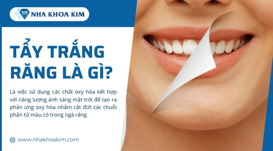 Tẩy trắng răng là gì?