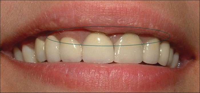 Có nên bọc răng sứ cho răng cửa? Chi phí hết bao nhiêu tiền? 2
