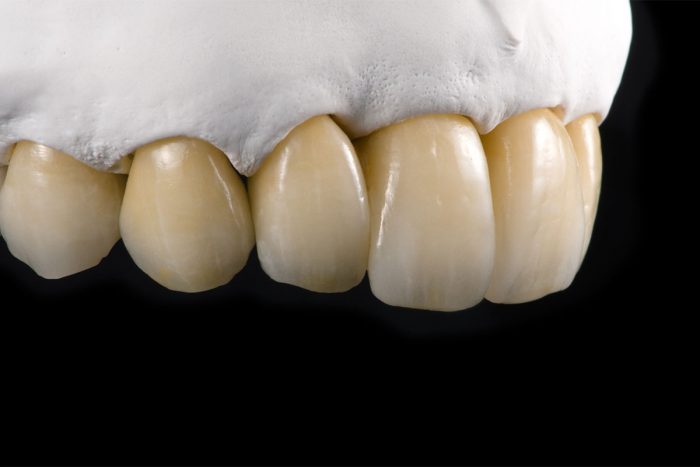 Bọc răng sứ có bền không và duy trì được bao lâu? 1