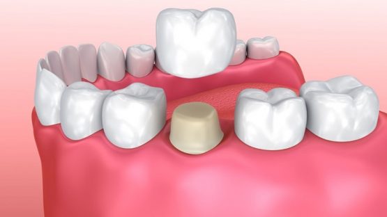 Bọc răng sứ có nguy hại cho sức khỏe răng miệng không?