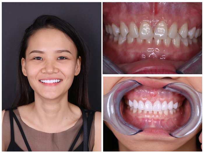 Bọc răng sứ giá rẻ tại Nha khoa KIM - đảm bảo giá rẻ răng vẫn đẹp! 9