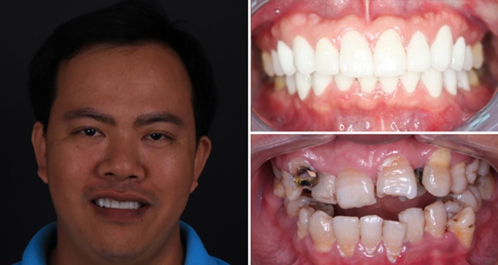 Răng bị thủng lỗ do sâu răng 4