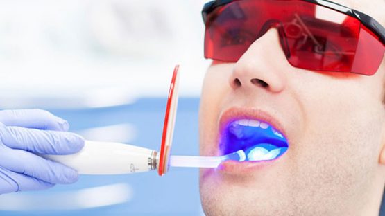 Nha Khoa Kim – Địa chỉ tẩy trắng răng không đau hiệu quả và uy tín