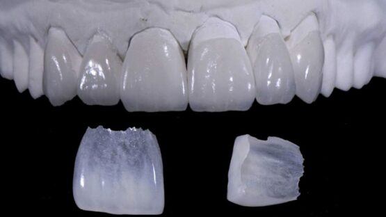 Đắp răng sứ – Giải pháp phục hình cho răng đẹp hoàn hảo, an toàn