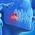 Có nên trồng răng số 8 sau khi đã nhổ răng rồi hay không? Có nên trồng răng số 8 sau khi đã nhổ răng rồi hay không?