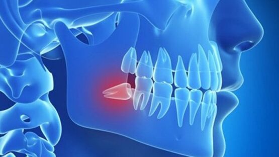 Có nên trồng răng số 8 sau khi đã nhổ răng rồi hay không?