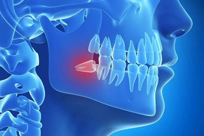 Răng khôn mọc lệch có thể xô lệch hoặc gây tổn thương đến các răng kề cạnh, đến xương hàm hoặc hệ thống thần kinh.