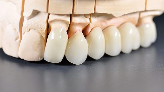Làm răng sứ thẩm mỹ – Giải pháp phục hình hoàn hảo cho răng