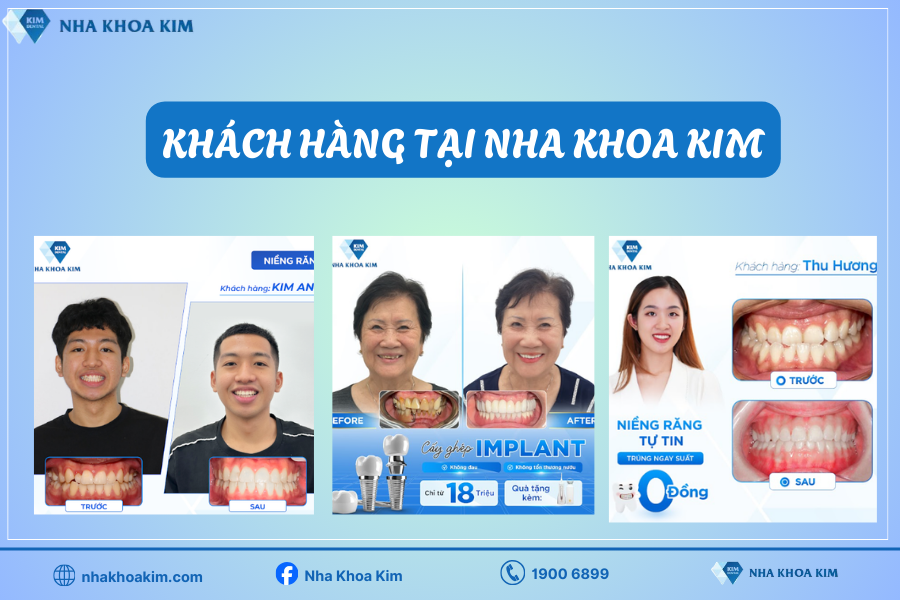 Hình ảnh khách hàng trước - sau khi sử dụng dịch vụ tại Nha Khoa Kim