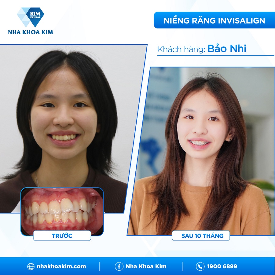 Hình ảnh khách hàng trước - sau khi tới với Nha Khoa Kim Tân Bình