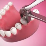 Nhổ răng hàm dưới – Trường hợp nào phải nhổ bỏ, có nguy hiểm không? Nhổ răng hàm dưới – Trường hợp nào phải nhổ bỏ, có nguy hiểm không?