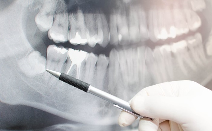 Sâu răng số 8 phải làm sao? Nên điều trị hay nhổ bỏ tốt hơn? 2