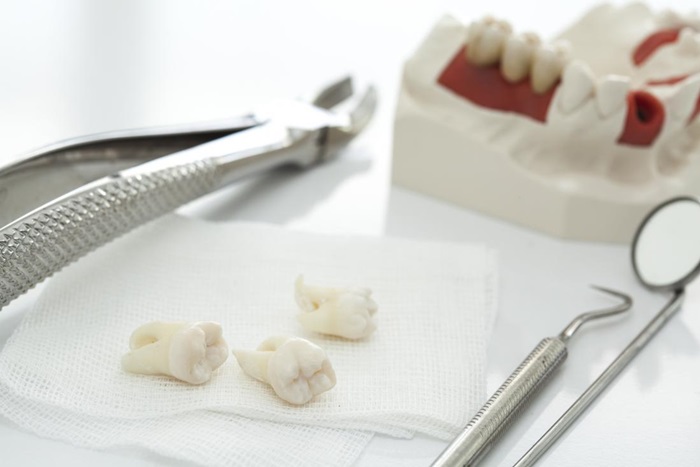 Sâu răng số 8 phải làm sao? Nên điều trị hay nhổ bỏ tốt hơn? 3